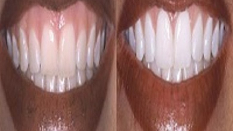 Zoom Teeth Whitening