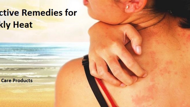 Effective Remedies for Prickly Heat That Work