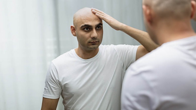 Hair Transplant – 3 Types of Hair Transplantation Methods