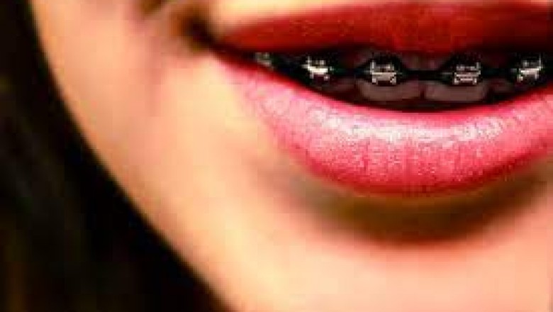 How Long Does It Take To Put Braces On?