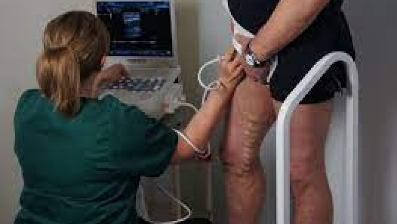 Harvard Trained Vein Doctor Texas