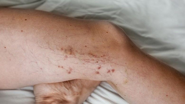 What to watch for while taking vein treatment at 50+?