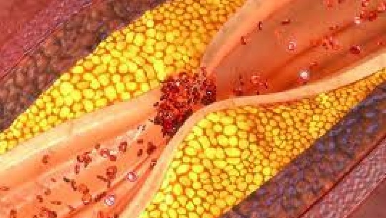 Treatments for hypertriglyceridemia; lifestyle and dietary changes can help lower high triglyceride levels