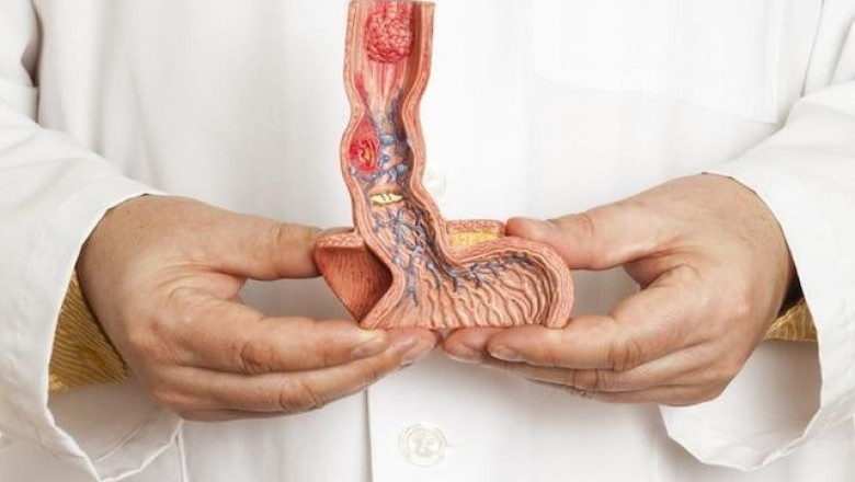 Gastric and Esophageal Cancer Drugs Market Trends Opportunity Analysis-2027