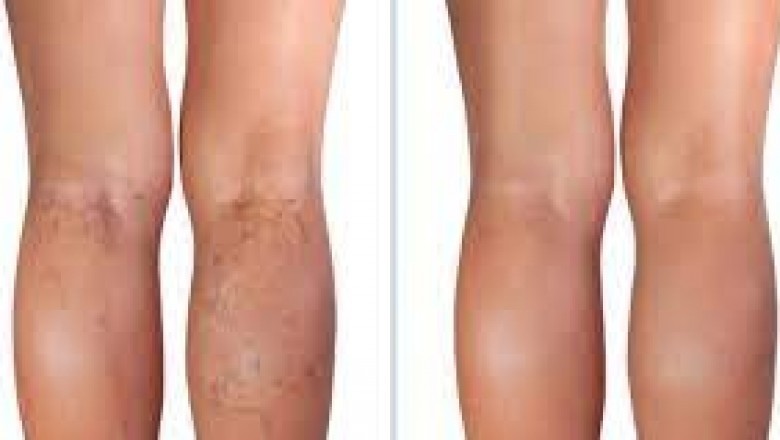Vein Treatment Center Near Me