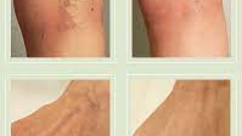 Vein Treatment Center