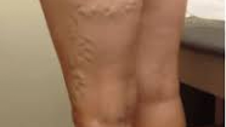 What Are The Various Ways To Treat CVI