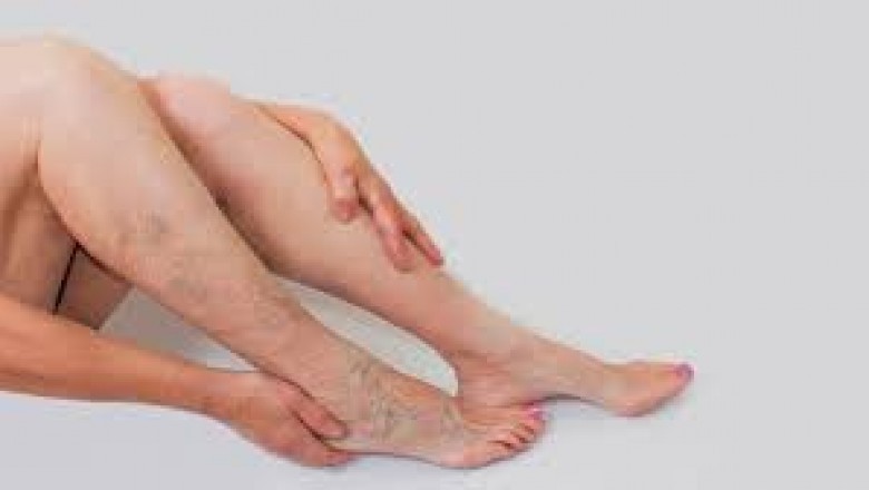 In What Manner Dermatologists Treat Spider & Varicose Veins?