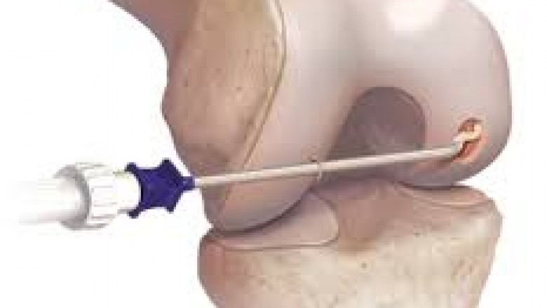 Autologous Matrix-induced Chondrogenesis procedures are commonly performed on people who have been injured in order to speed up the healing of their fractures