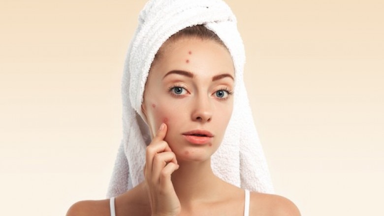 How to Remove Blackheads from your Face