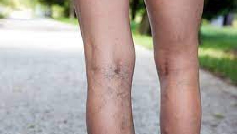 Varicose Veins Center Near Me
