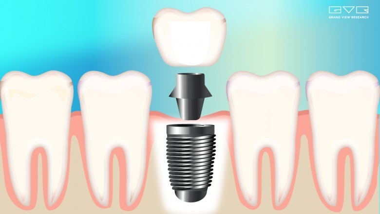 Dental Implant Market Size Worth $8.0 Billion By 2028