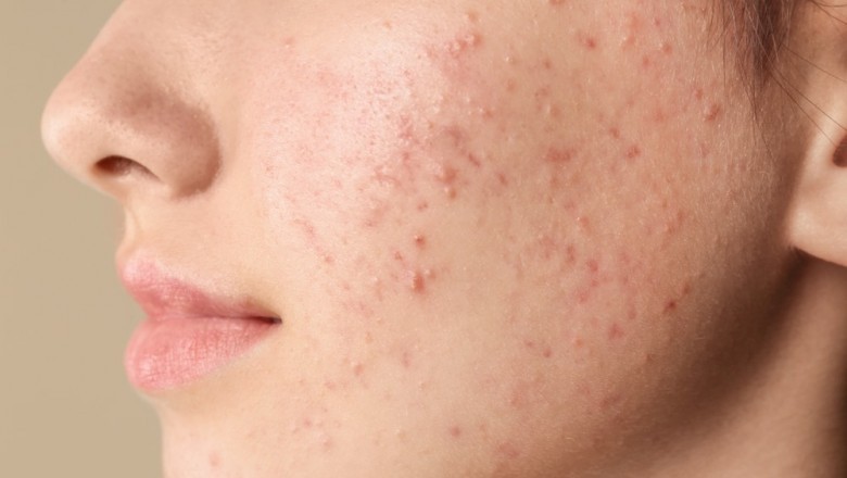 How to Remove Pimples - Why Herbal Medicines are the Best Treatment to Remove Pimples ?
