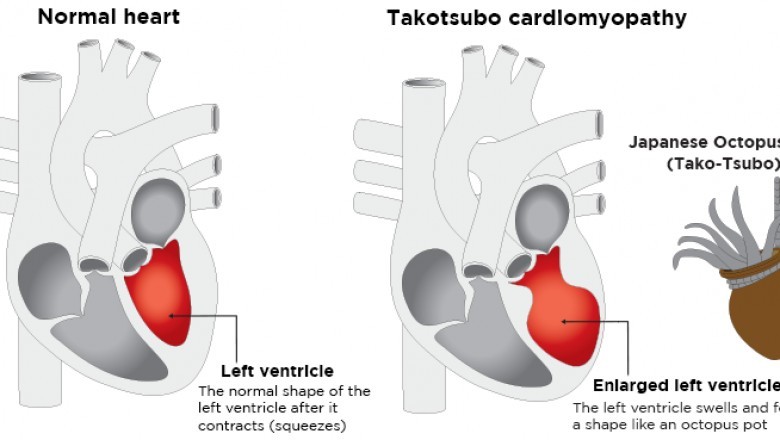 Emerging Trends in Takotsubo Cardiomyopathy Market 2018 and Global Foreseen Till 2028 | Top Key Vendors – GSK, Sun Pharma, Teva, Sanofi, Pfizer