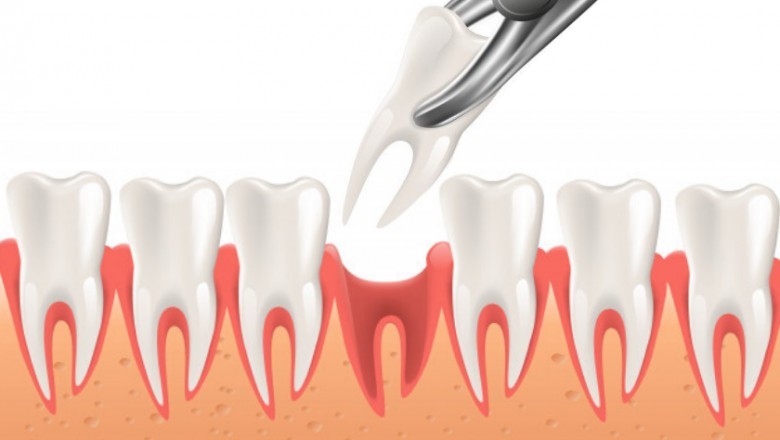 What is the Process of Tooth Extraction?