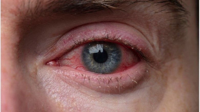 Blepharitis Treatment Market | Trends,Size, Growth, Share, COVID-19 Impact ...