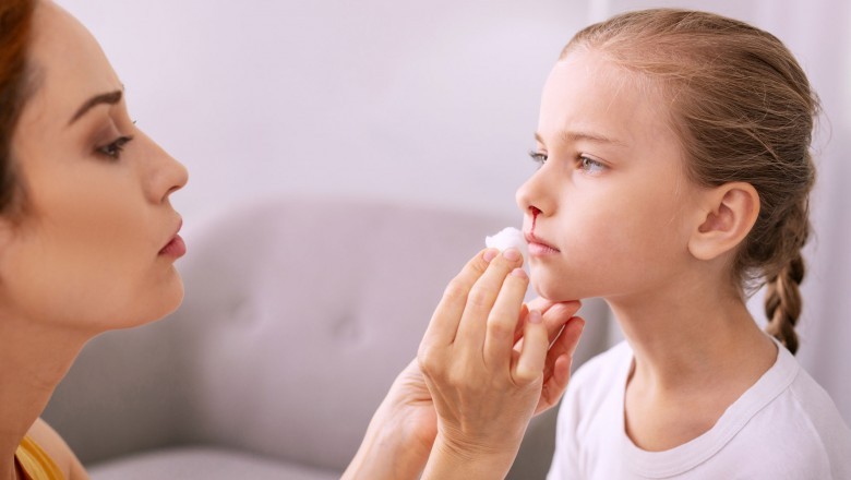 Home Remedy For Nose Bleed - Atural Remedies For Nose Bleeding