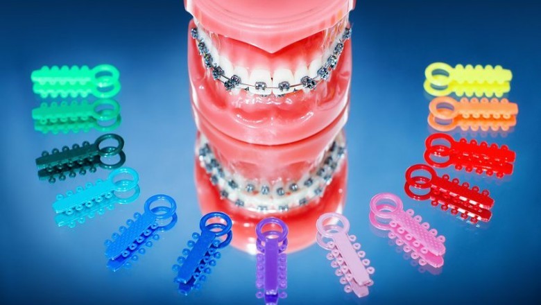 Make your Teeth Look Beautiful By Using Colorful Braces!