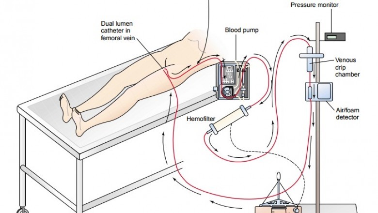 Comprehensive Study on Continuous Renal Replacement Therapy Market 2021-2028: Business Opportunity and Recent Development Analysis by Baxter, B. Braun, Medtronic