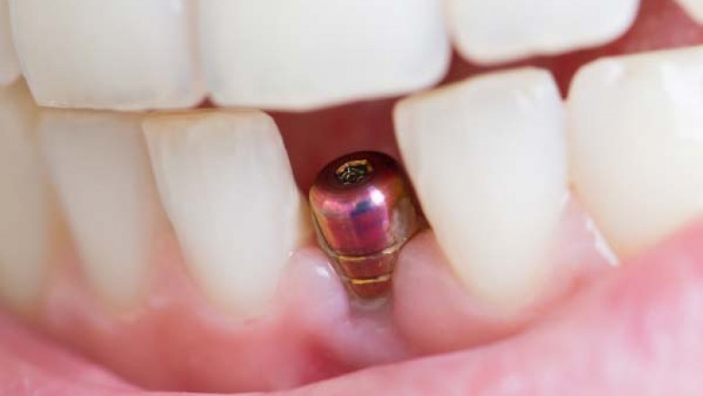 EVERYTHING YOU NEED TO KNOW ABOUT DENTAL IMPLANTS