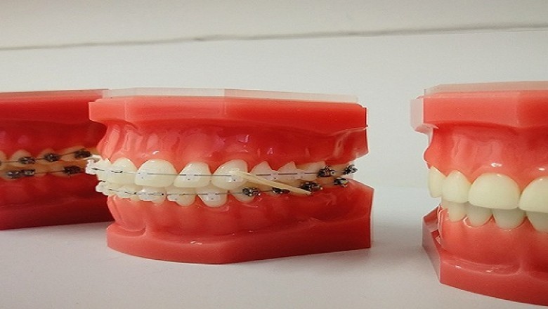 Facts To Know About Orthodontics!