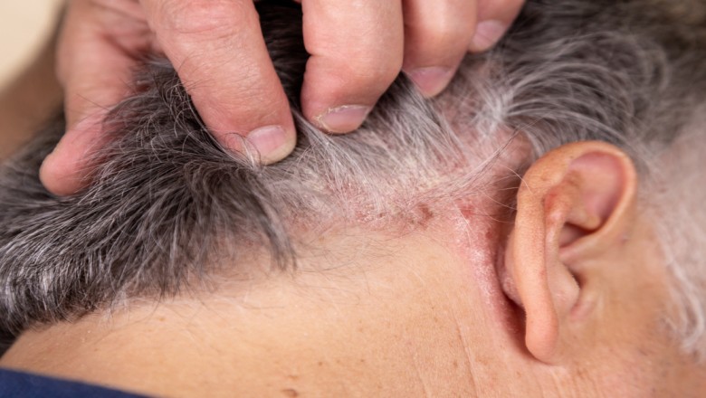 If Psoriasis is not treated, what will happen?