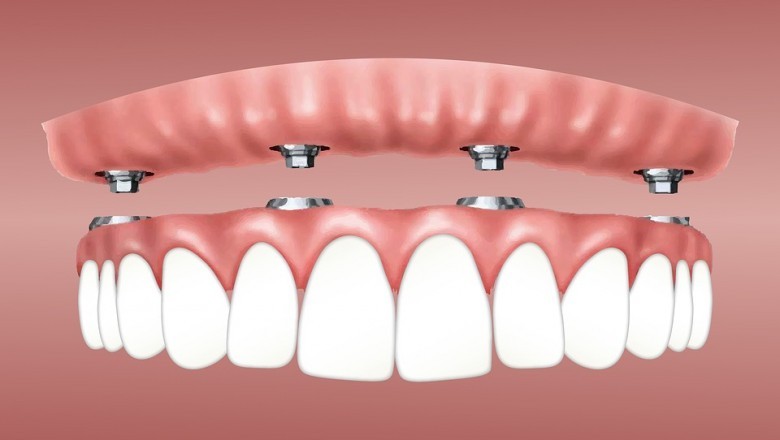 Dental Veneers; What To Know About Them?