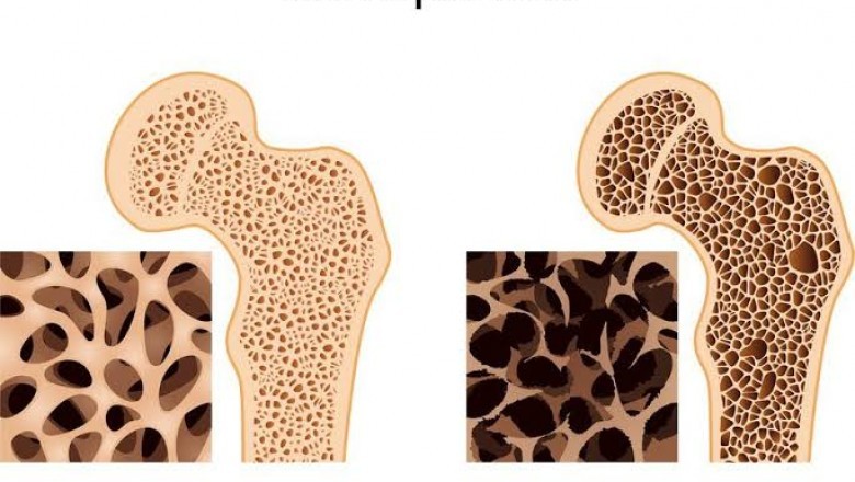 Erectiestoornissen: Hoe osteoporose leidt tot erectiestoornisen bij mannen
