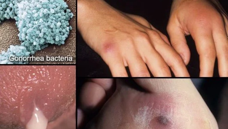 Natural Cure For Syphilis - Syphillis Side Effects