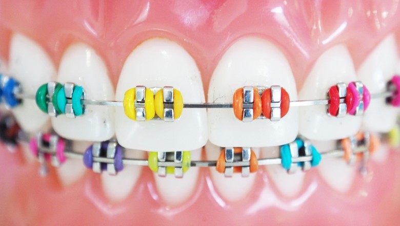 How Orthodontic Braces are Applied?