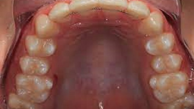 Problems and Failure Causes of Dental Implants