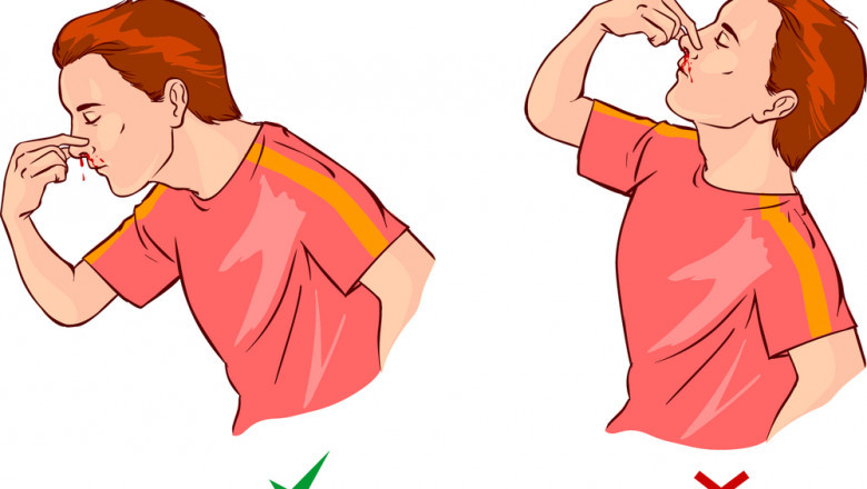 Herbs For Nose Bleeding - How To Stop A Bloody Nose