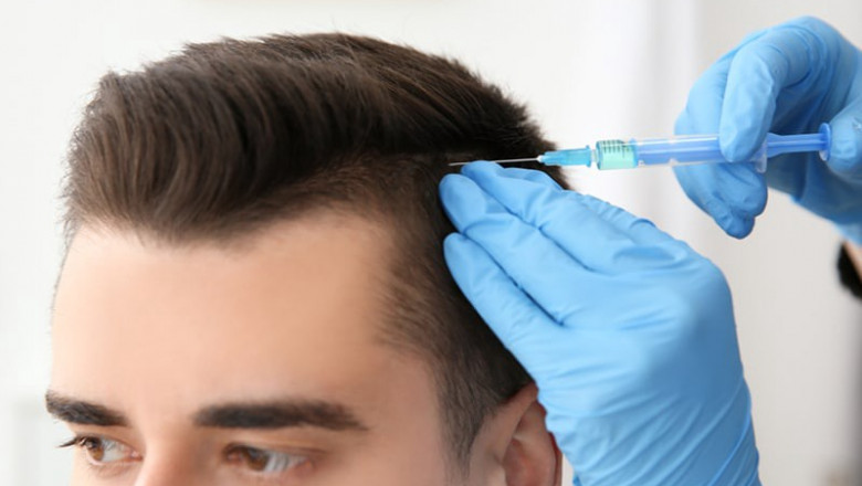 Benefits of Hair Transplant Surgery