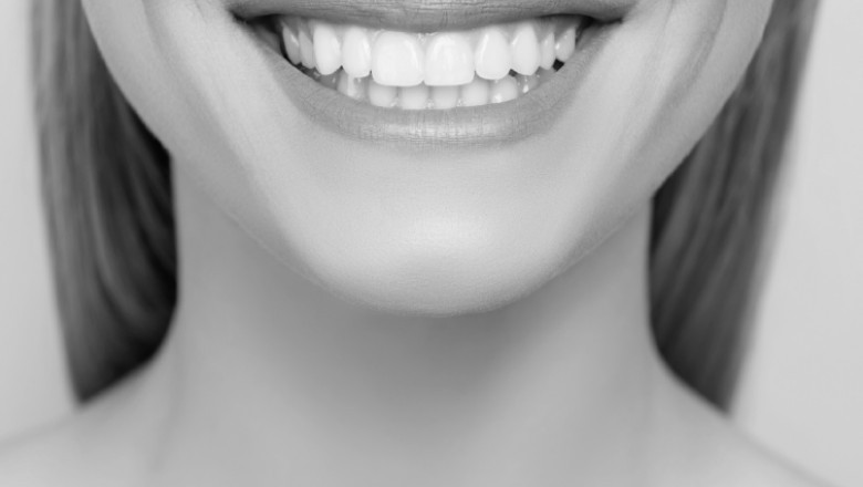 How Dental Bonding Can Give You a Smile Like No Other?