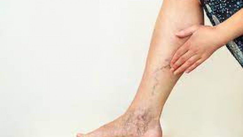 Scrutinize the Best Varicose Vein Treatment For You!