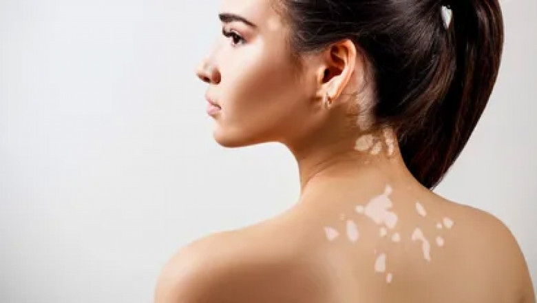 Herbs For Leucoderma - Best Herbs For Leucodrma Treatment