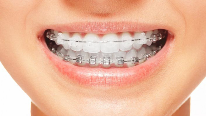 How Do Orthodontists Use Invisalign for The Dental Alignment?
