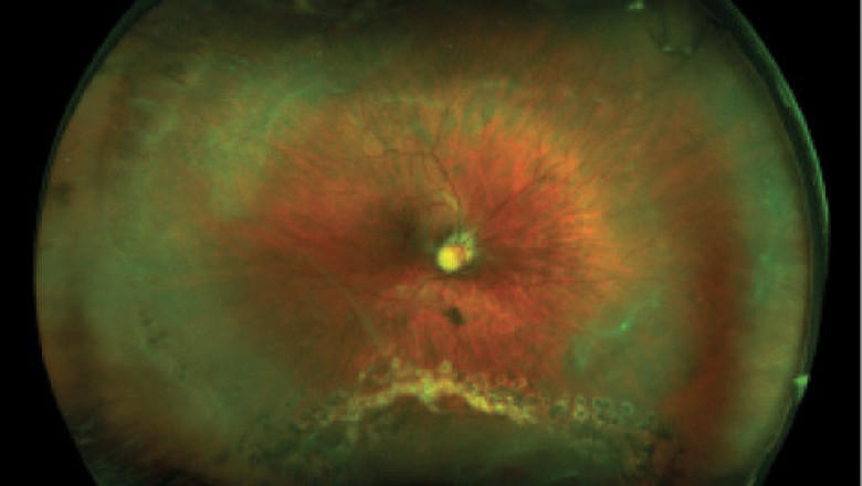 Pediatric Vitrectomy Market Projected To Be Resilient During 2027
