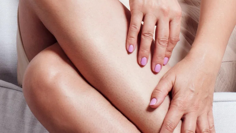 What are the superfoods for Varicose Veins? Check here