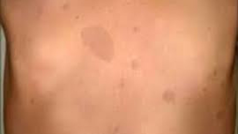 Neurofibromatosis Type-1 Market Structure And Its Segmentation For The Period 2027