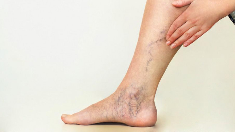 Top Secrets To Get Gorgeous and Vein Free Legs!