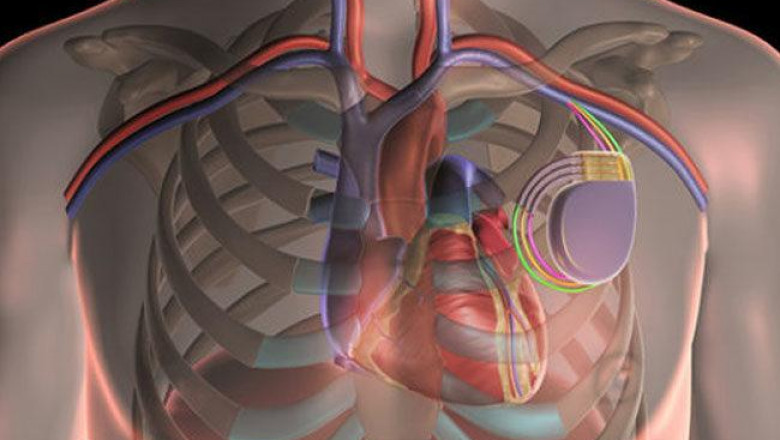 A cardiac implant is a type of advanced medical device that is implanted into the patient's body during cardiac surgery so that the heart has proper functioning.