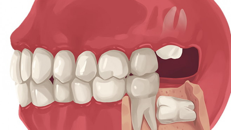 Orthodontic Braces For Kids