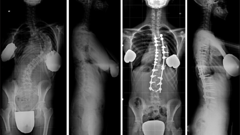 Spinal Implants Market Growth Latest Analysis Report, Post Covid Growth Projection, High CAGR 5.5% to 2027