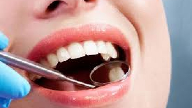 Replace Teeth With Implants