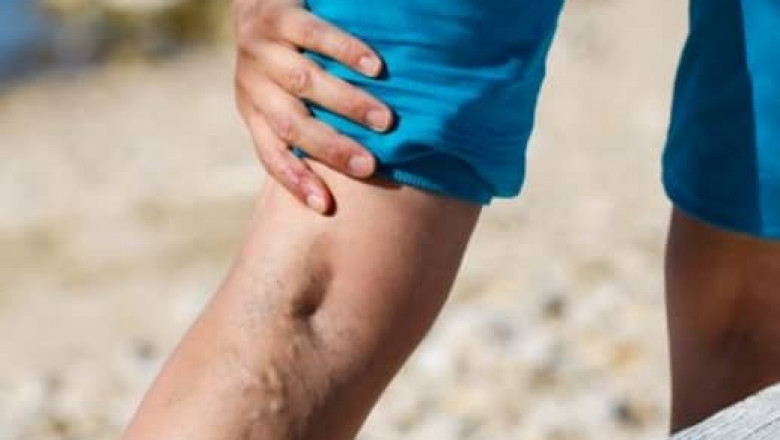 Can Varicose Veins Become Critical? Know-How