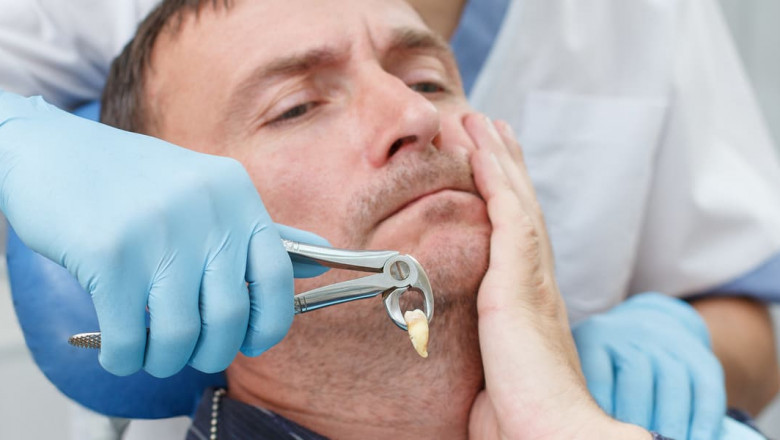 What are the Post Surgery Problems of Impacted Wisdom Teeth?