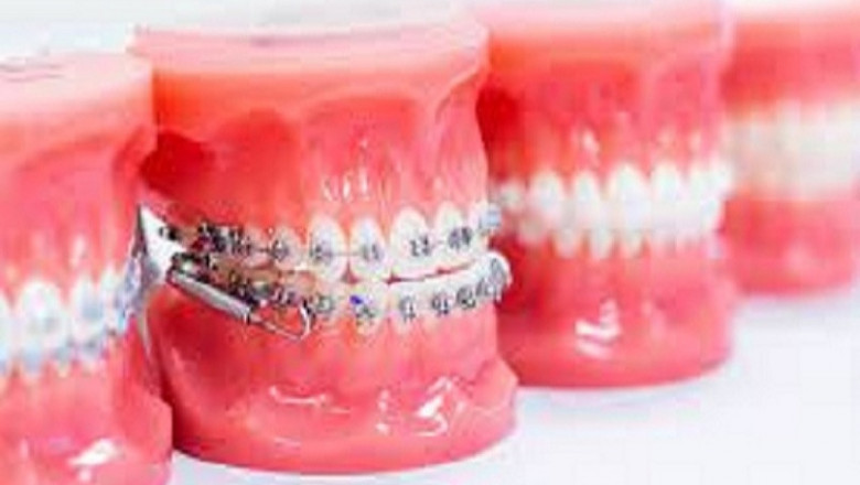 What is Root Canal Procedure and Aftercare Procedure?
