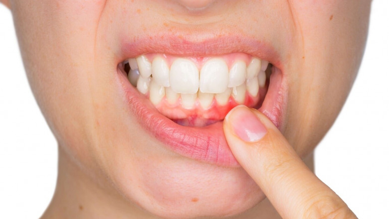 Laser Gum Recontouring