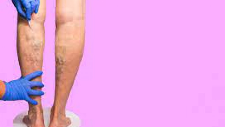 Spider Veins: What Are The Advanced Treatments?